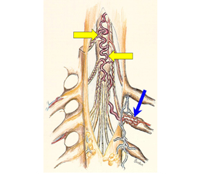 脊髄硬膜動静脈瘻の模式図