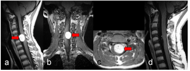 脊髄硬膜内髄外腫瘍の術前MRI