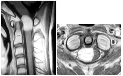 脊髄硬膜内髄外腫瘍の術前Gd造影後MRI