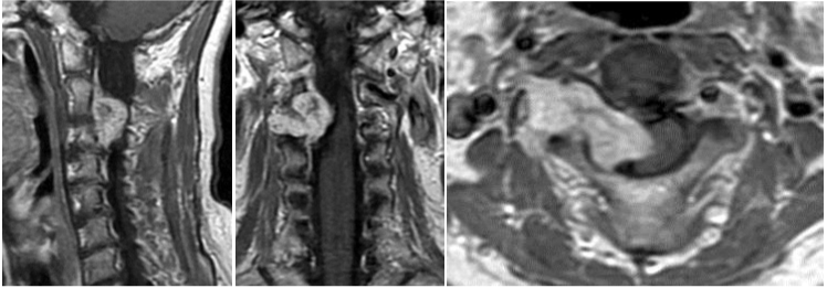 ダンベル型脊髄神経鞘腫のGd造影後MRI