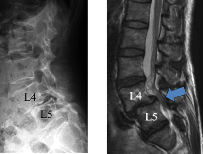 PLIF術前腰椎X線および腰椎MRI
