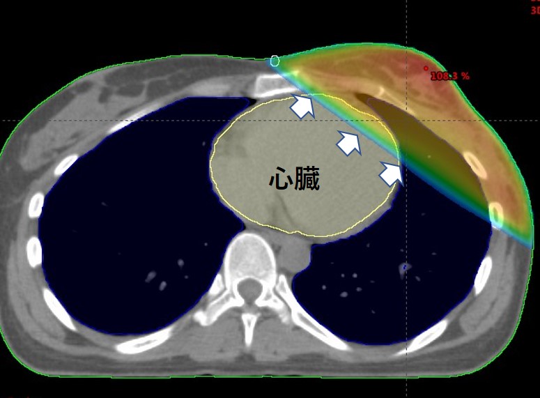 乳がん放射線治療の副作用と予防 総合東京病院 公式 中野区 練馬区 24時間救急受入