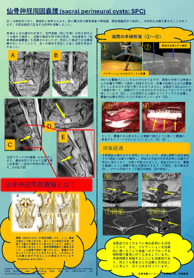 仙骨神経周囲嚢腫