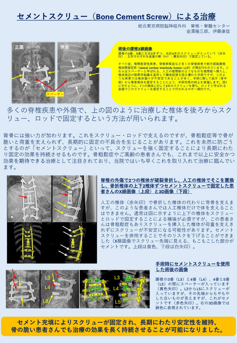 セメントスクリュー