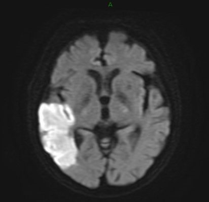 脳梗塞のMR画像