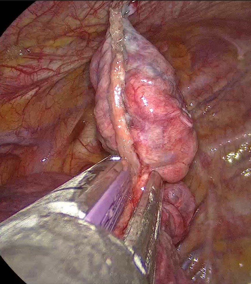 エンドステープラーをつかった胸腔鏡手術