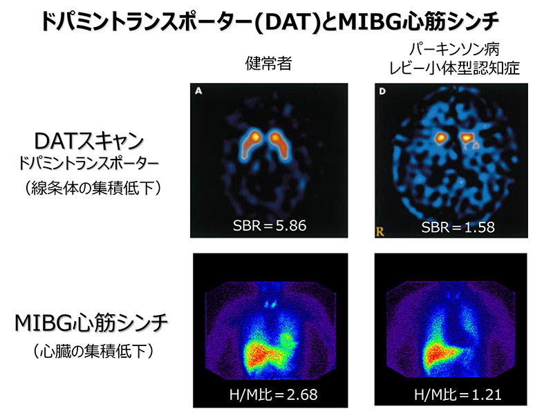 DAT-Scan