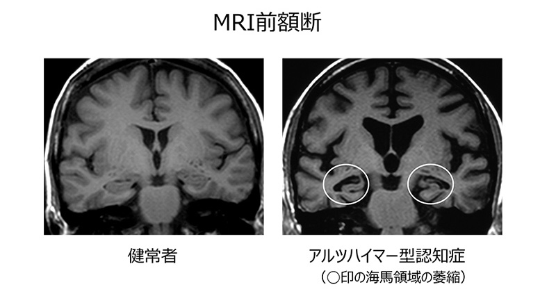 アルツハイマー病のMRI前額断